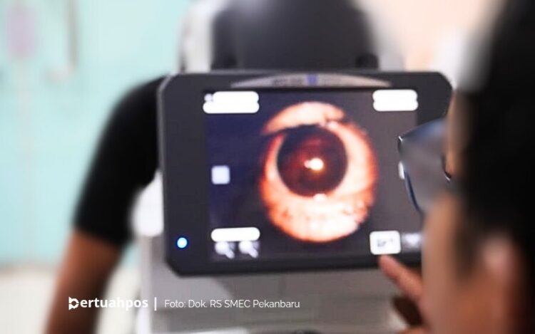 SMEC Pekanbaru Gelar Operasi Katarak Gratis untuk 100 Pasien Selama 5 Bulan Berturut-turut