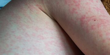 Penyakit Campak 18 Kali Lebih Menular Dibanding COVID-19