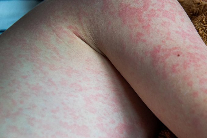 Penyakit Campak 18 Kali Lebih Menular Dibanding COVID-19