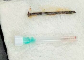 Ini Bukan Santet, Dokter Paru RSUD Arifin Achmad Berhasil Keluarkan Paku Sepanjang 5 cm dari Paru-paru Pasien Berusia 52 Tahun